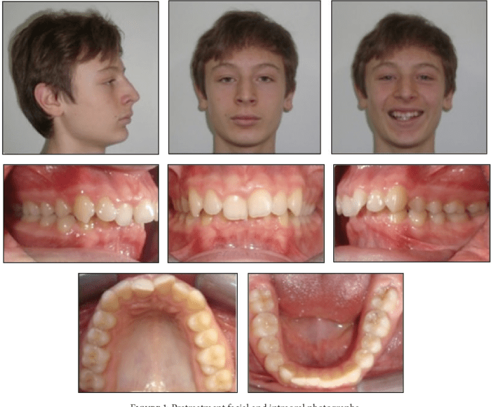 Class ii malocclusion division 1