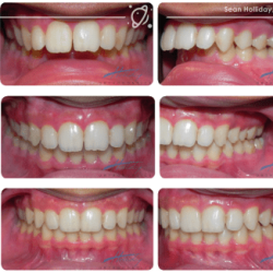 Class malocclusion ii division treatment angle initial records figure patient