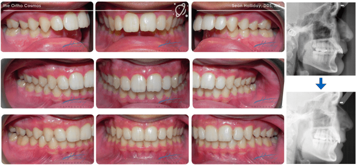 Class malocclusion ii division treatment angle initial records figure patient