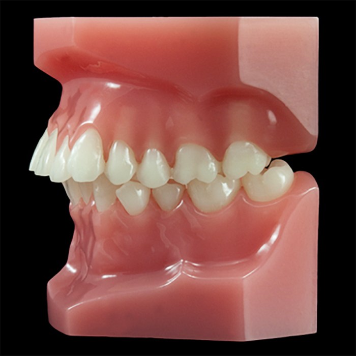 Class ii malocclusion division 1