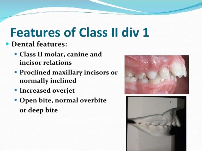 Class ii malocclusion div slideshare